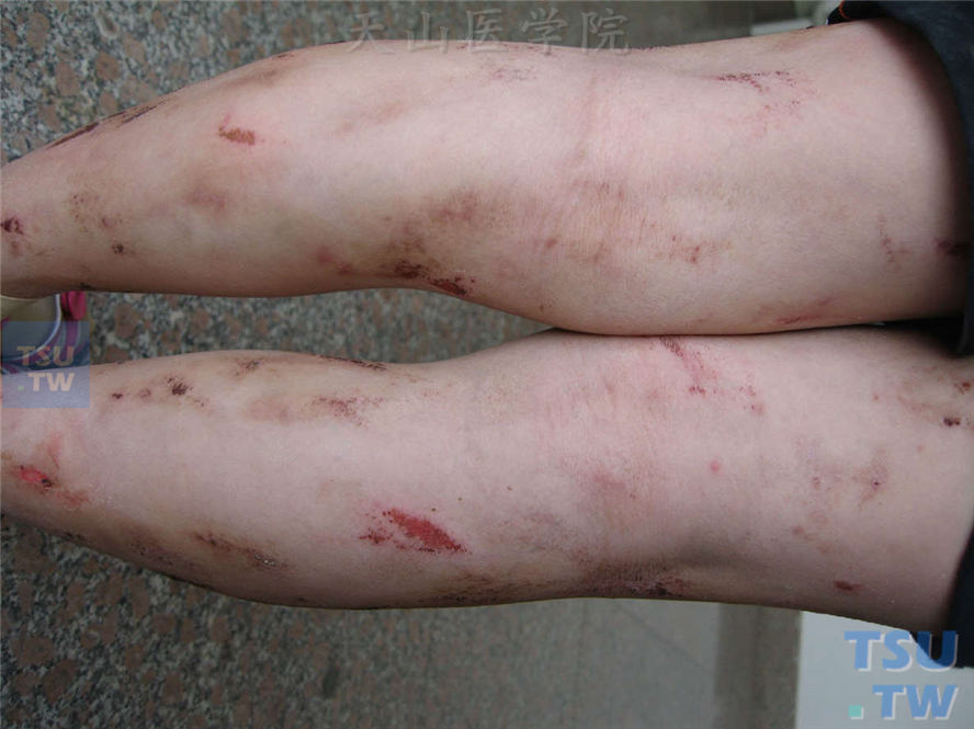 皮肤瘙痒症（pruritus）的症状表现