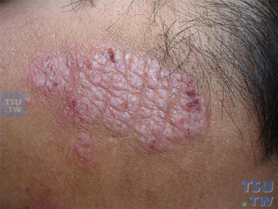 【图】慢性单纯性苔藓(神经性皮炎)的症状表现 - 皮肤