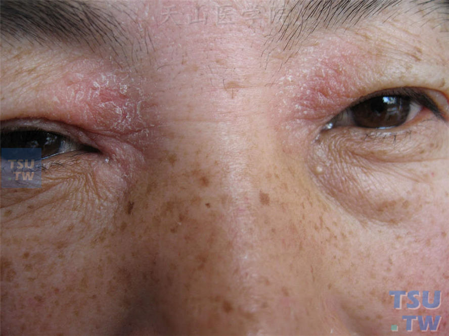 【图】慢性单纯性苔藓(神经性皮炎)的症状表现 - 皮肤