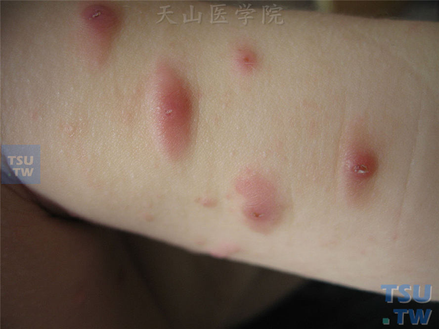 痒疹：急性单纯性痒疹的症状表现