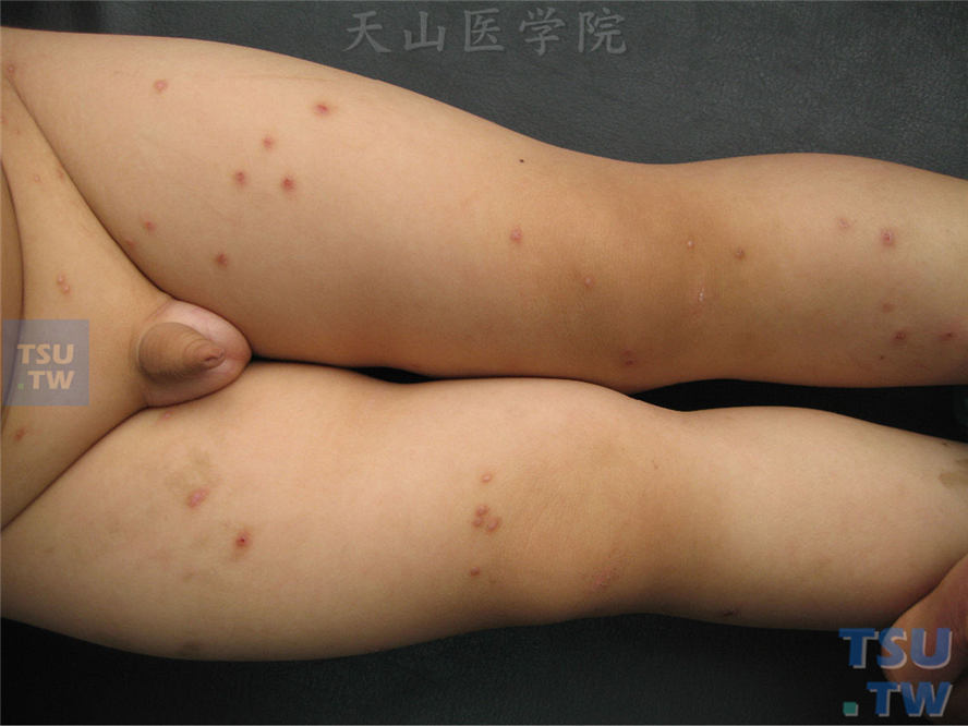 痒疹：早发性痒疹（Hebra痒疹）的症状表现