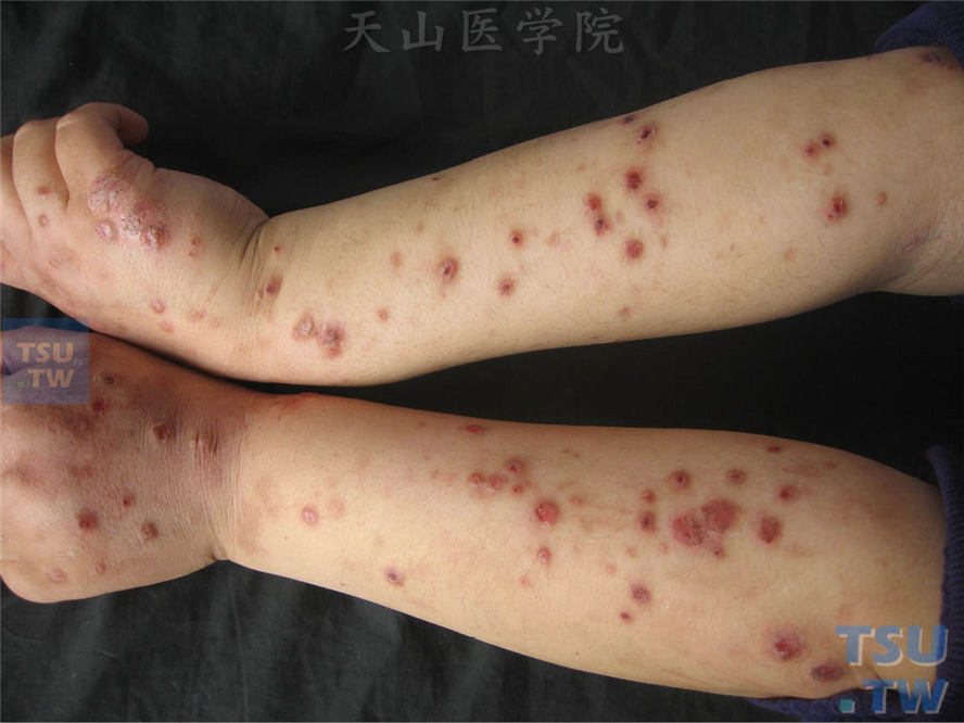 痒疹：结节性痒疹（Prurigo Nodularis）的症状表现