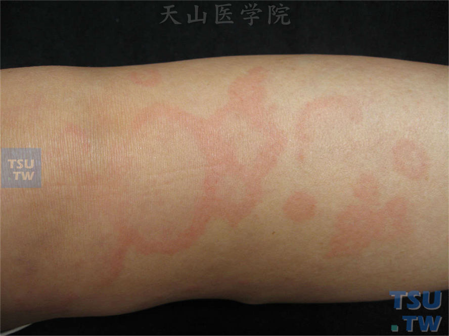 【图】远心性环状红斑的症状表现 皮肤病诊断图谱 天山医学院