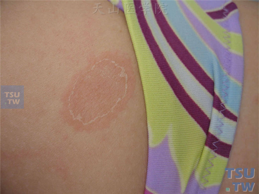 玫瑰糠疹（pityriasis rosea）的症状表现