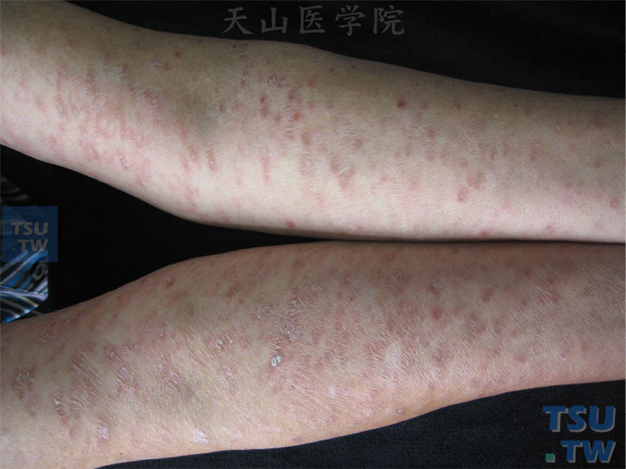【图】急性痘疮样苔藓状糠疹的症状表现 - 皮肤病诊断