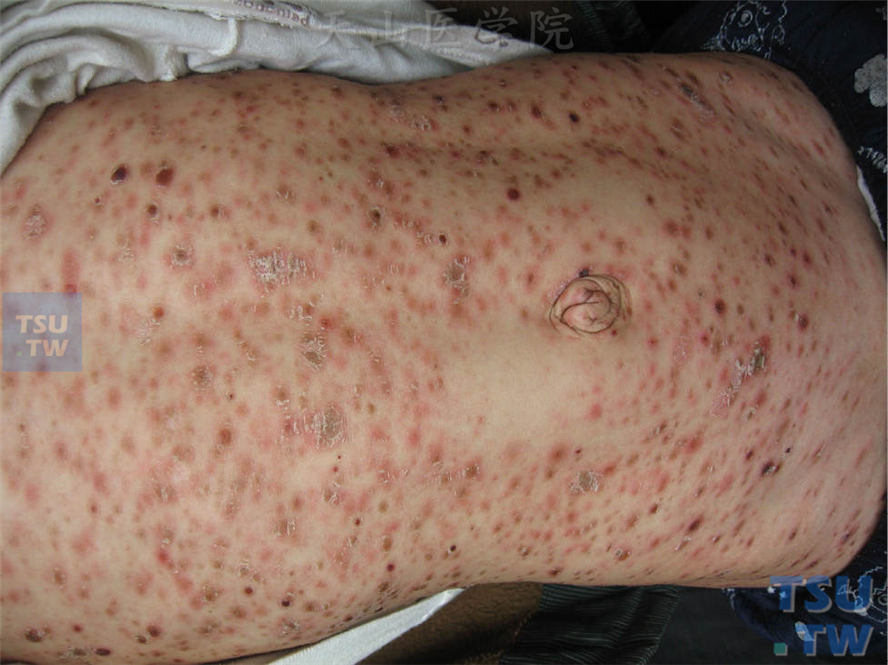 急性痘疮样苔藓状糠疹的症状表现