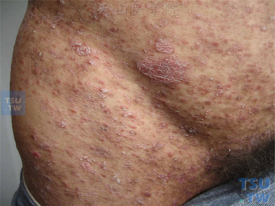 点滴状副银屑病（parapsoriasis guttata）症状表现