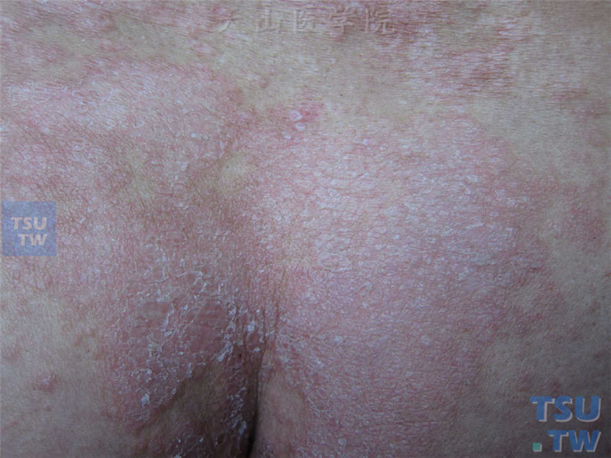 斑块型副银屑病（parapsoriasis en plaques）症状表现