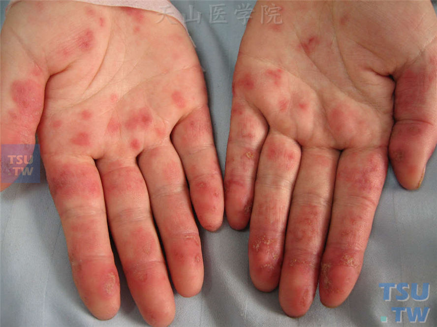 系统性红斑狼疮-同一病人,手掌,手指掌侧毛细血管扩张性红斑,部分红斑