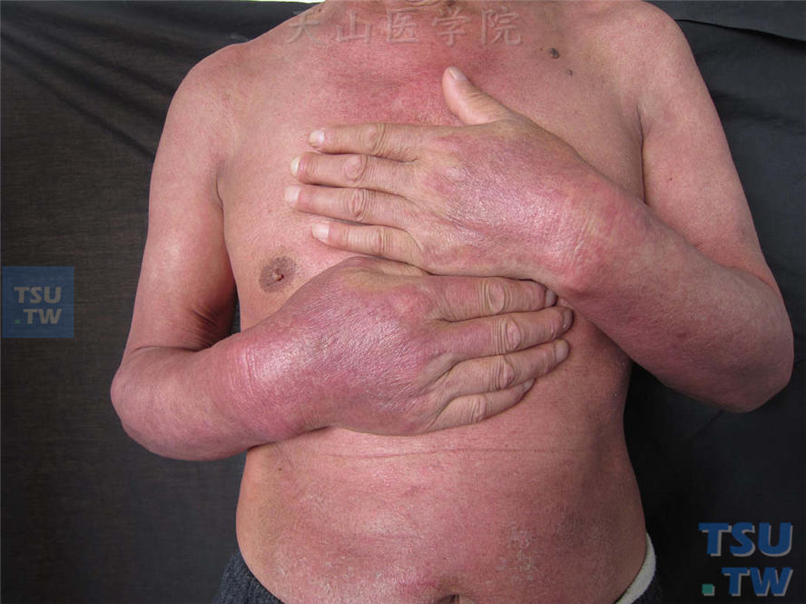 皮肌炎（dermatomyositis）的症状表现