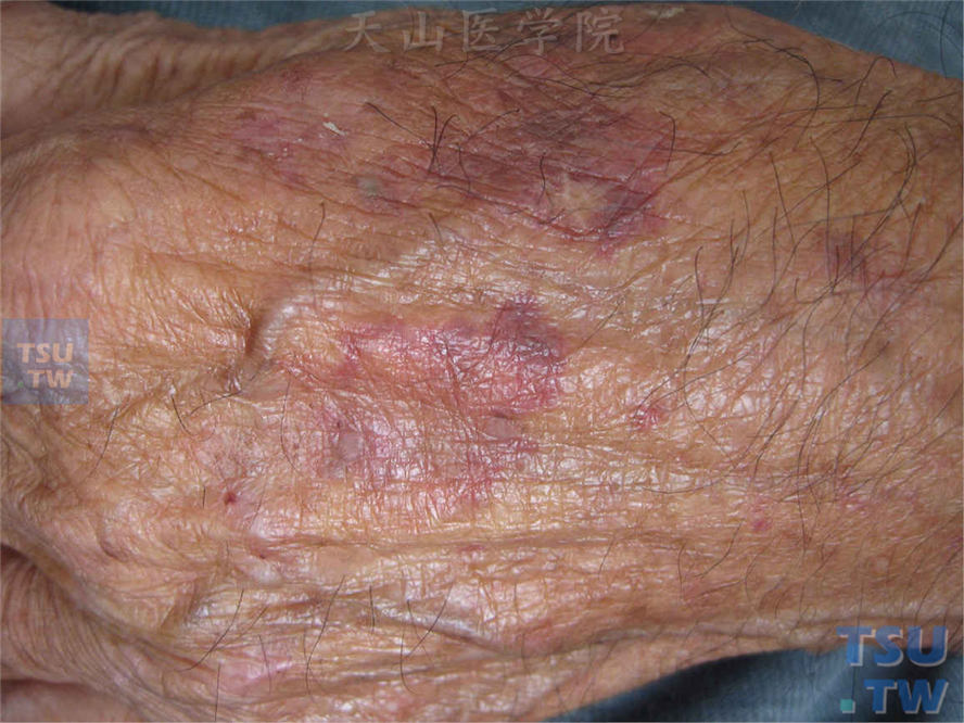 老年性紫癜（purpura senilis）症状表现