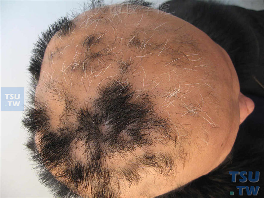 斑秃（alopecia areata）症状表现