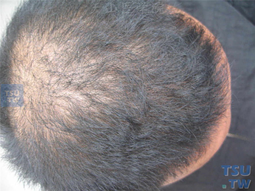 羊毛状发（woolly hair）症状表现