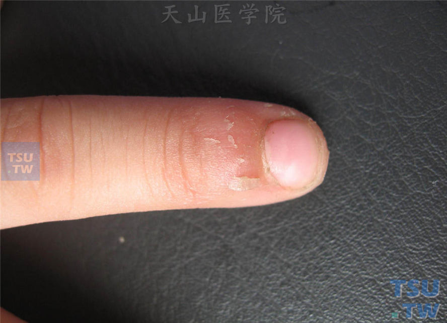 指甲处皮肤逆剥（倒刺）的症状表现