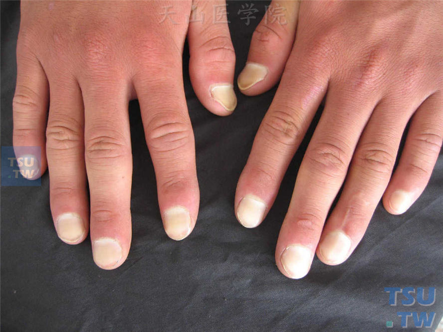 白甲（指甲发白或有白点）的症状表现