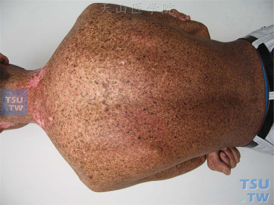 着色性干皮病（xeroderma pigmentosa）症状表现