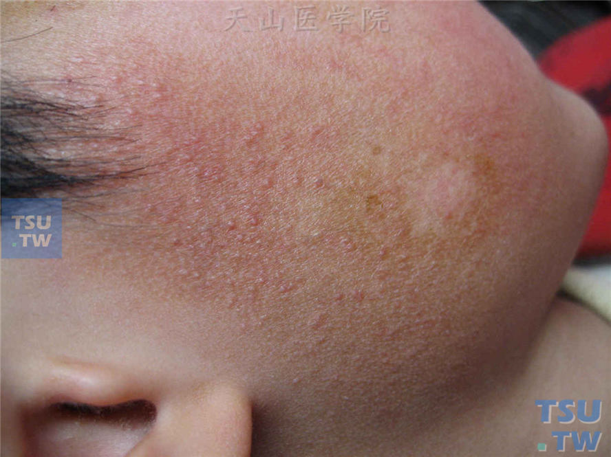 面颈部毛囊性红斑黑变病的症状表现