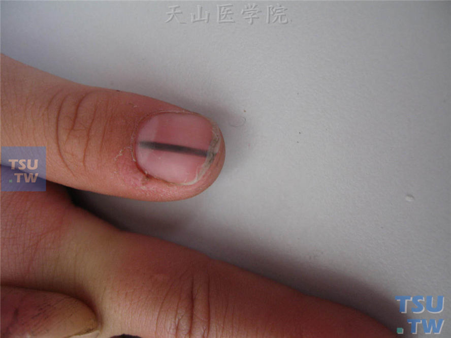 甲母痣（nevus of the nail matrix）症状表现