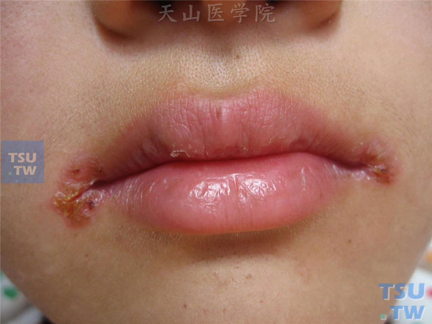 口角唇炎（angular cheilitis）症状表现