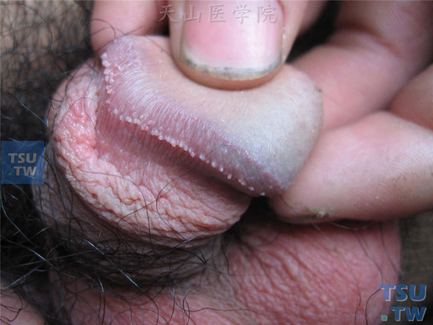 阴茎珍珠样丘疹（龟头边缘一排小肉芽）症状表现