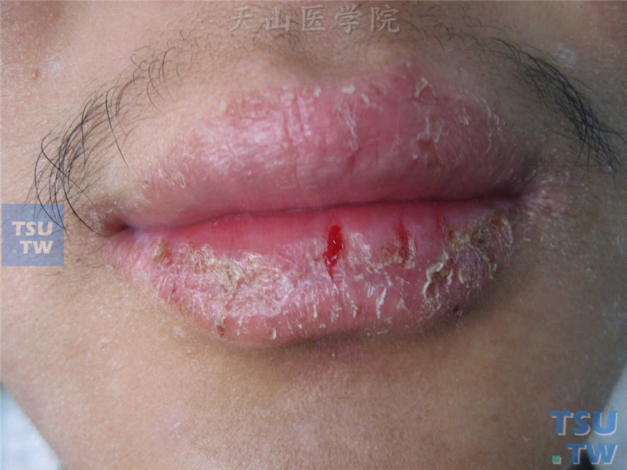 剥脱性唇炎（exfoliative cheilitis）症状表现