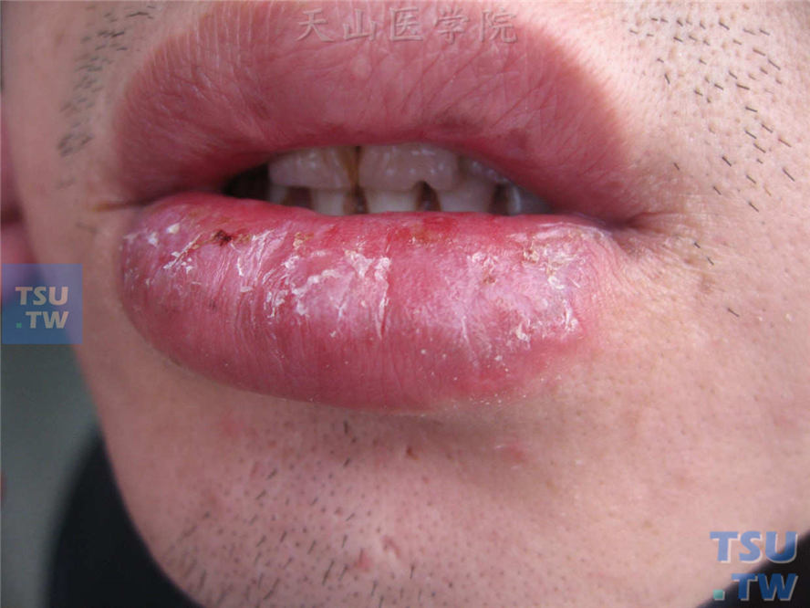 光化性唇炎(actinic cheilitis)症状表现