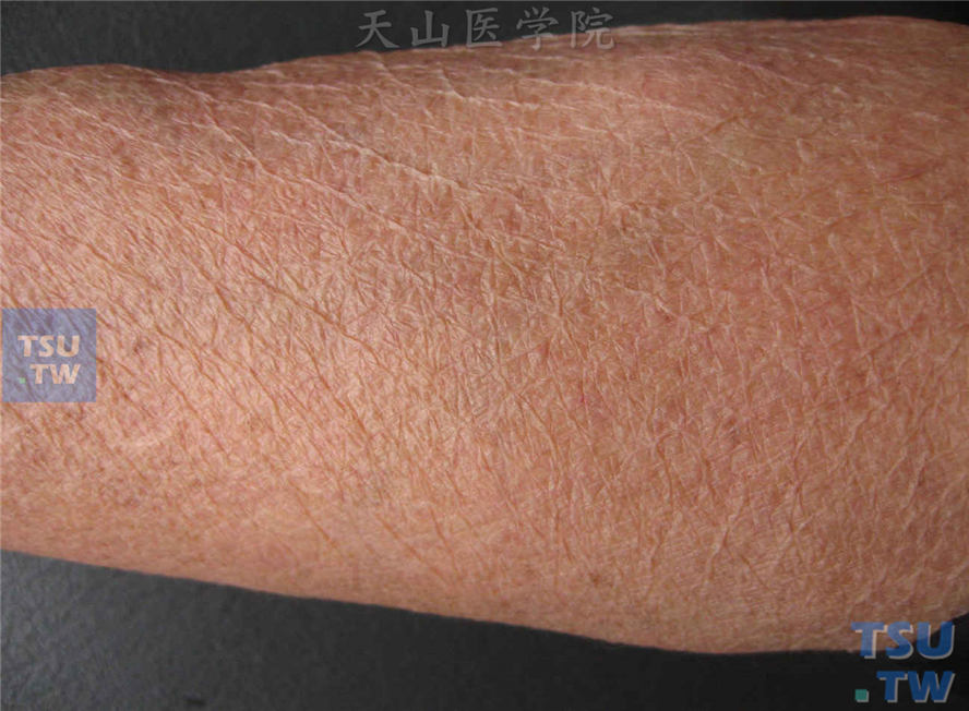 老年性皮肤萎缩（atrophia cutis senilis）症状表现