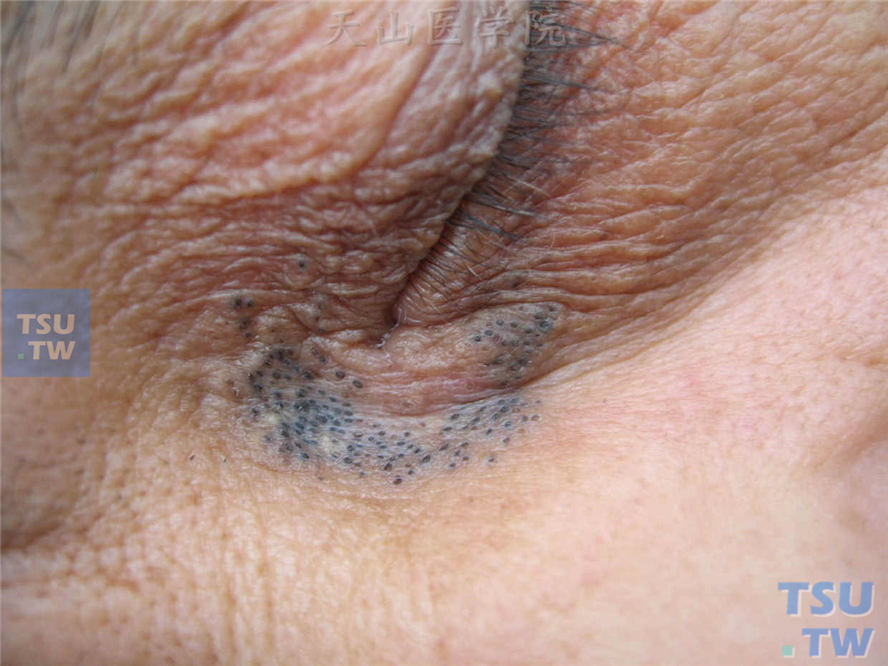 良性肿瘤：黑头粉刺痣（comedo nevus）症状表现