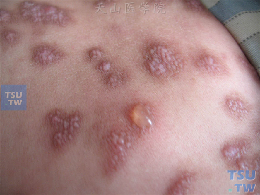色素性荨麻疹（urticaria pigmentosa）症状表现