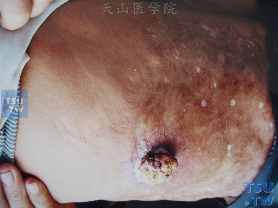 恶性肿瘤:鳞癌的症状表现