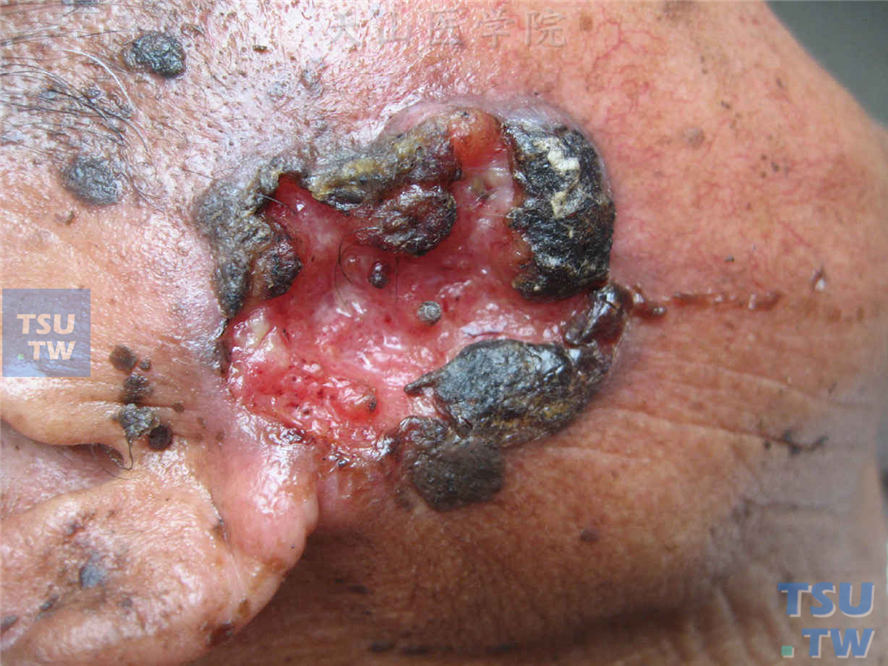 恶性肿瘤：毛鞘癌（trichilemmal carcinoma）症状表现