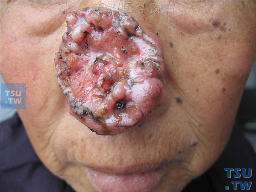 恶性肿瘤：腺样鳞状细胞癌的症状表现