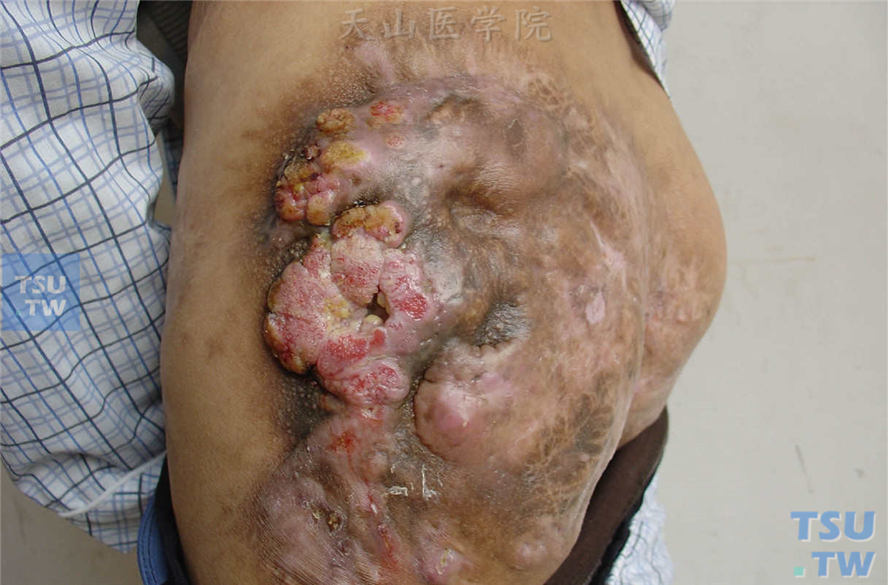 恶性肿瘤：疣状癌（verrucous carcinoma）症状表现