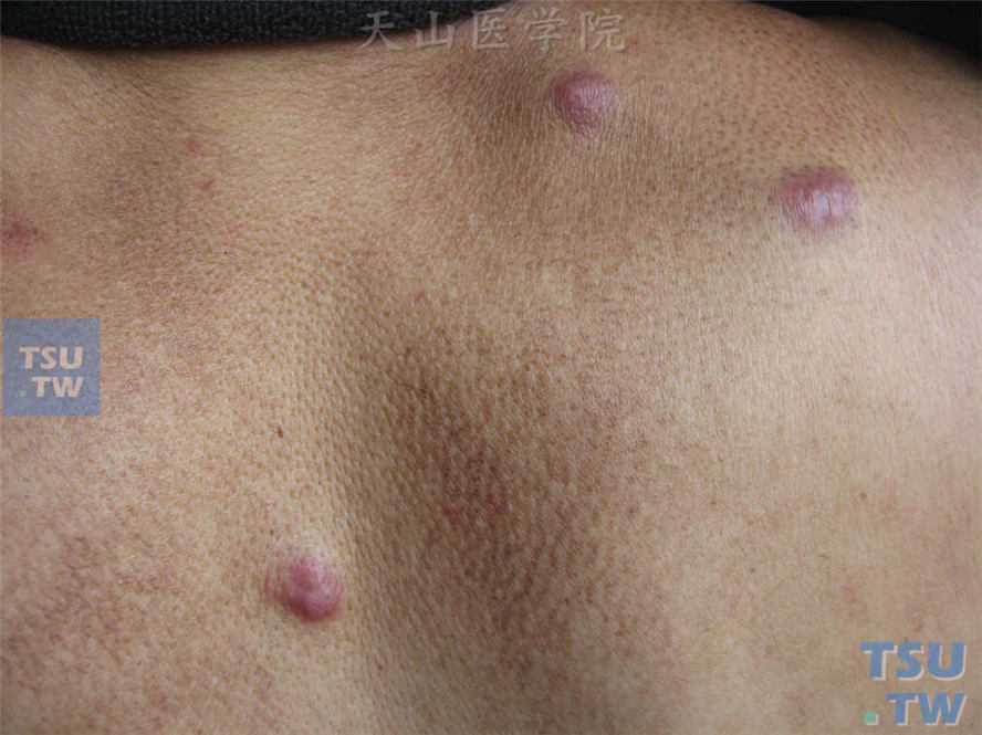 恶性肿瘤:皮肤转移癌的症状表现
