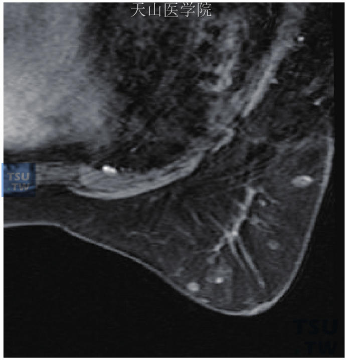 乳腺其他恶性肿瘤的MRI表现