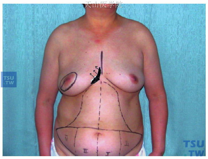 乳腺癌自体组织的乳房重建