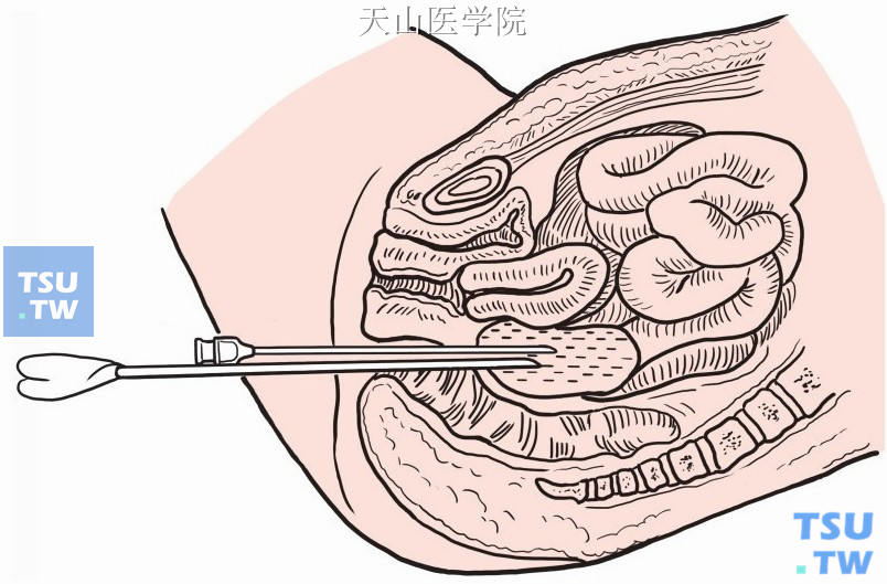 盆腔脓肿经直肠切开引流术