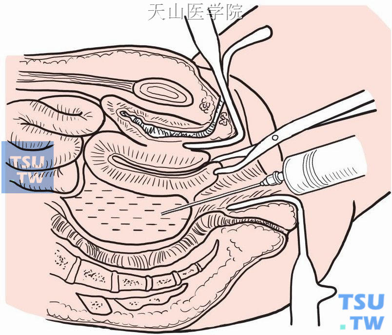 盆腔脓肿经阴道切开引流术