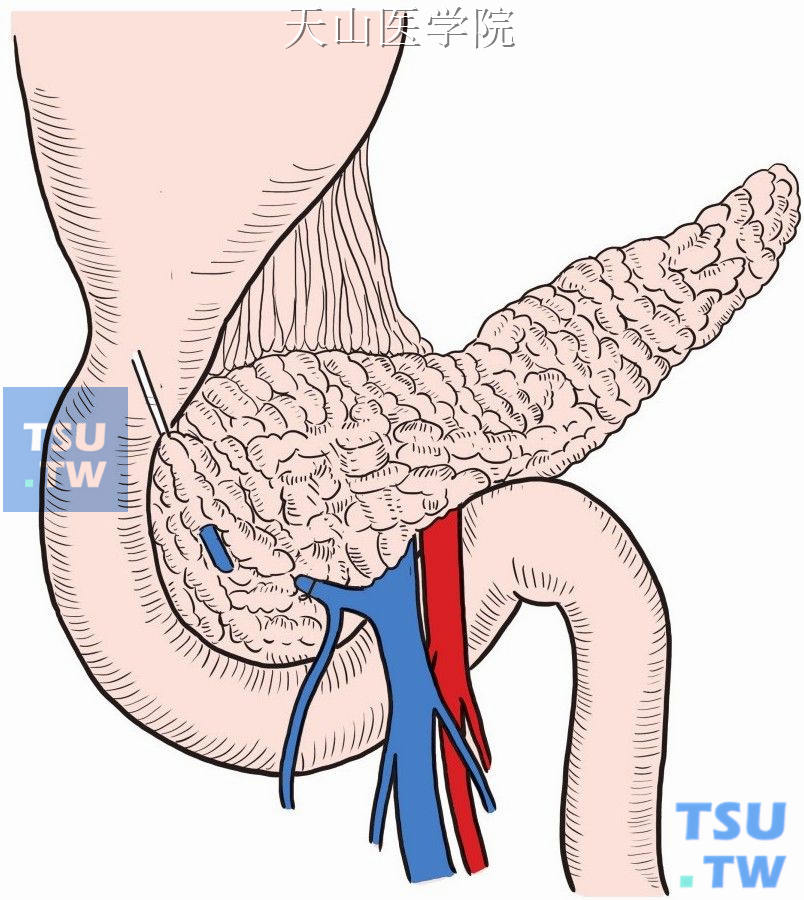 沿肠系膜上静脉主干解剖胃结肠静脉干,沿胃结肠静脉干解剖胃网膜右