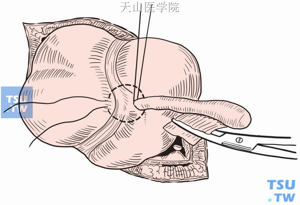 增:阑尾切除手术(阑尾炎)