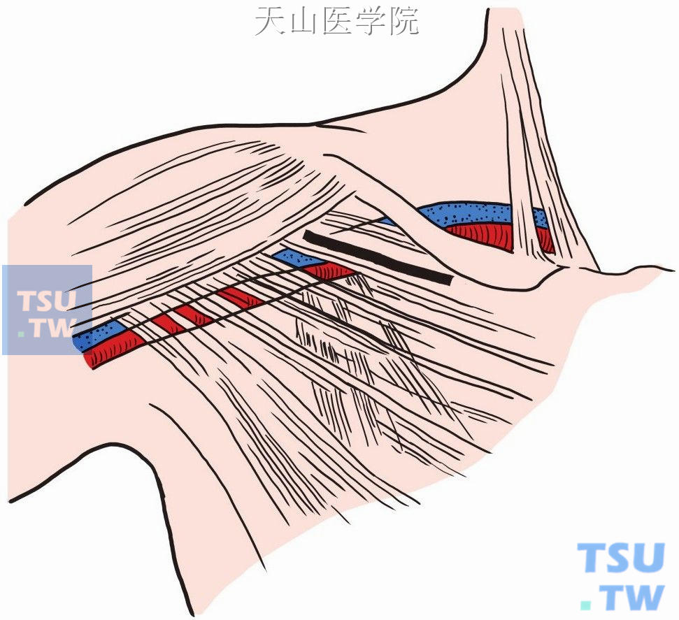 腋股动脉旁路术
