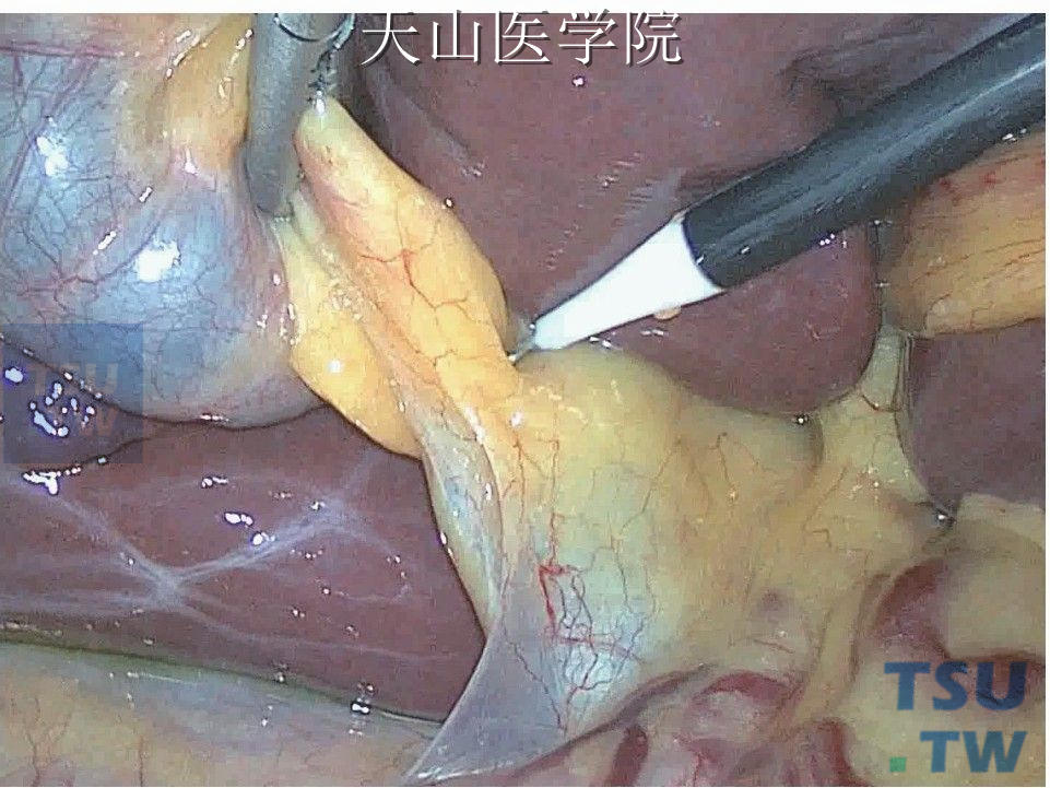 腹腔镜胆囊切除术