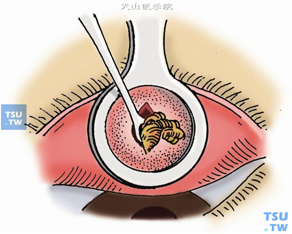 睑板腺囊肿刮除术步骤及临床经验