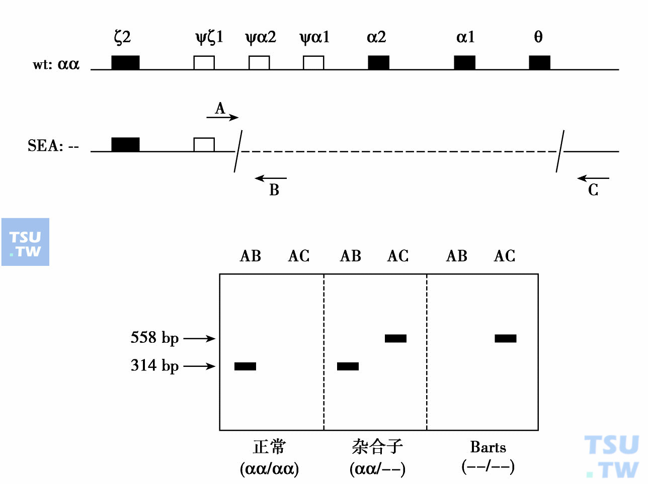  缺口PCR诊断Bart水肿胎引物设计与扩增结果示意图