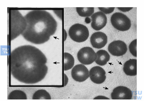  G-6-PD缺乏症患者“咬痕”红细胞（bite cells）