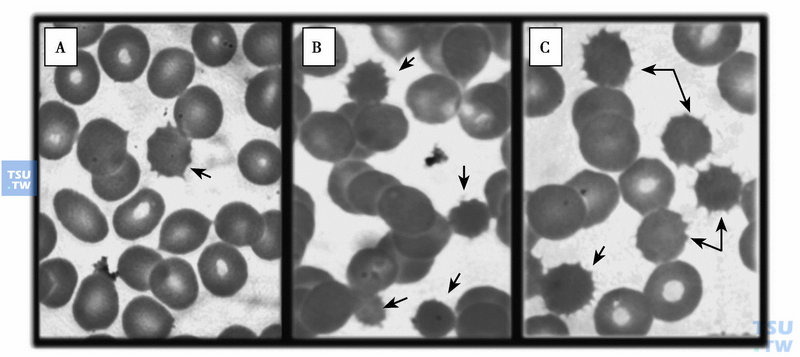  PK缺乏症外周血涂片小棘球形红细胞：A.切脾术前，偶见棘球形红细胞，红细胞中空区缩小；B、C.切脾术后，小棘球形红细胞明显增多