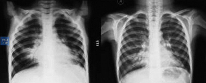  7岁CVID患儿，确诊前反复下呼吸道感染4年。支气管扩张症-CXR-1和2:感染治疗前后胸部X线片比较