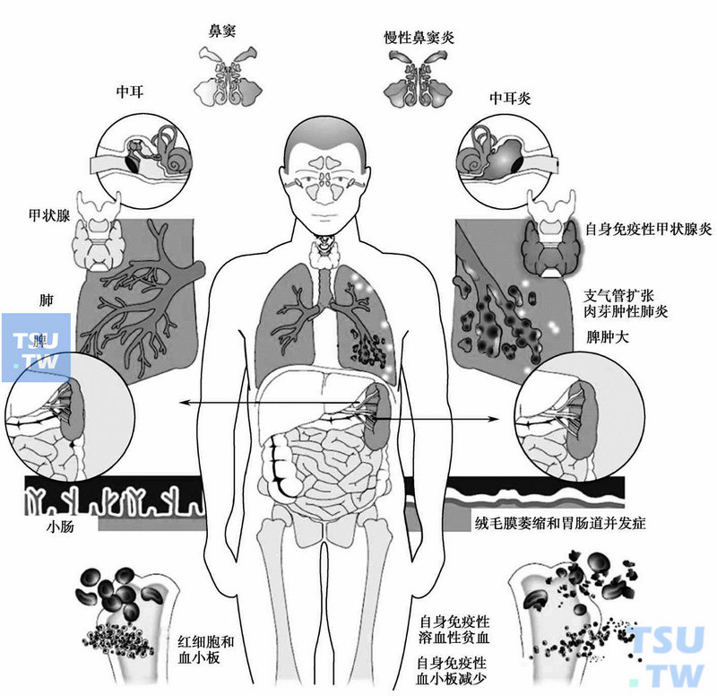  CVID的临床关系