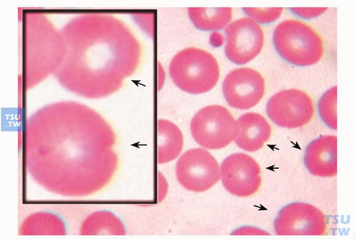  G-6-PD缺乏症患者“咬痕”红细胞（bite cells）