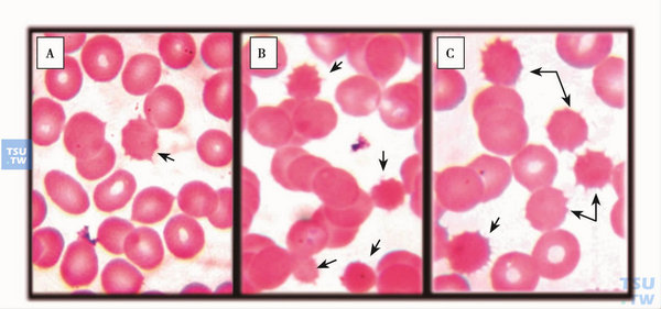  PK缺乏症外周血涂片小棘球形红细胞；A.切脾术前，偶见棘球形红细胞，红细胞中空区缩小；B、C.切脾术后，小棘球形红细胞明显增多